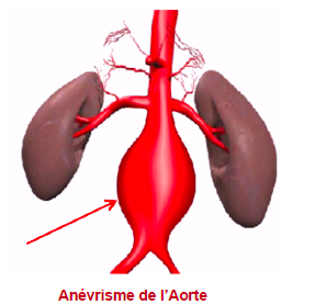Opération dépistage de l’anévrisme de l’aorte abdominale